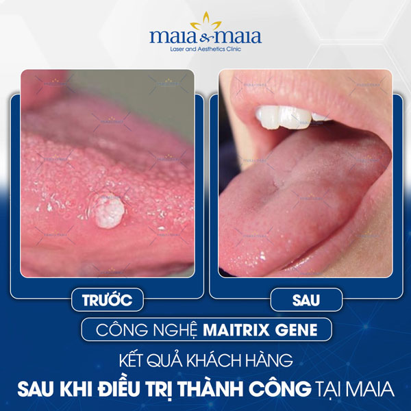 khách chữa sùi mào gà