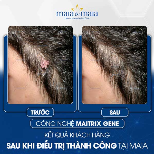 khách điều trị sùi mào gà