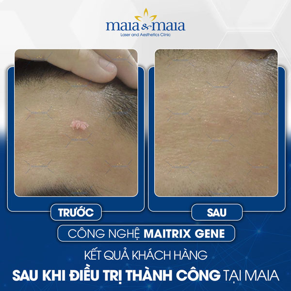 khách trị sùi mào gà tại maia