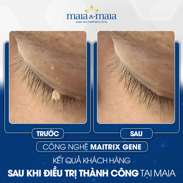 khách trị sùi mào gà