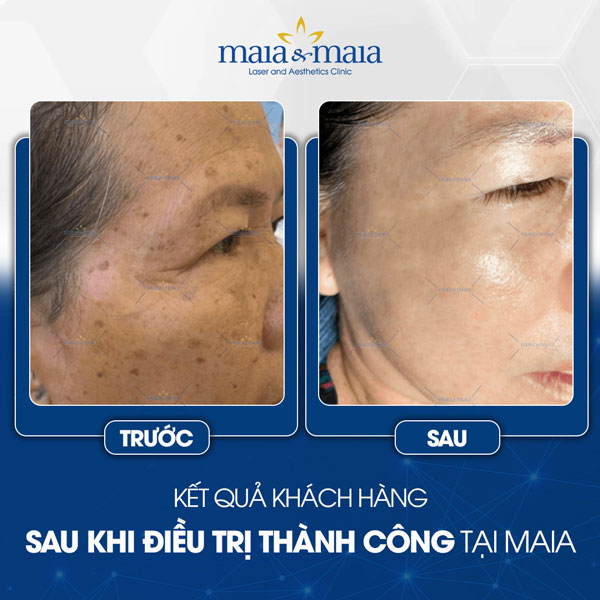 khách trị đồi mồi tại maia