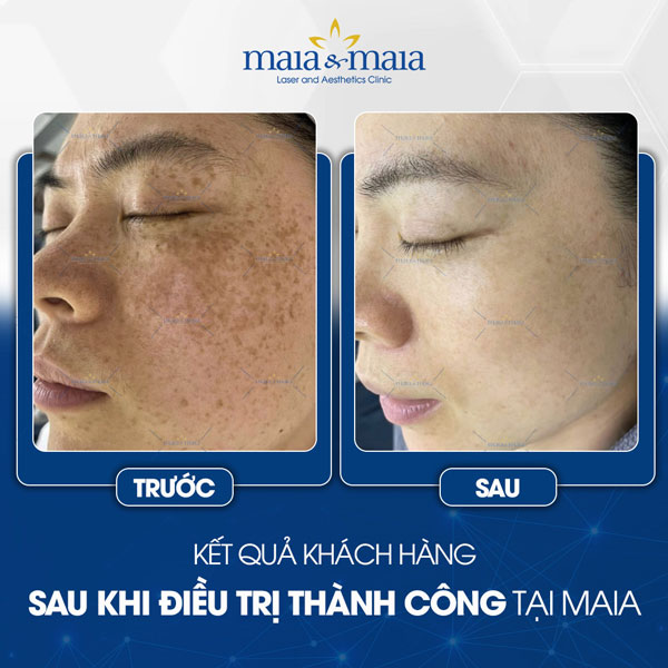 khách trị đồi mồi thành công tại maia