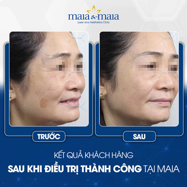 khách trị đồi mồi thành công