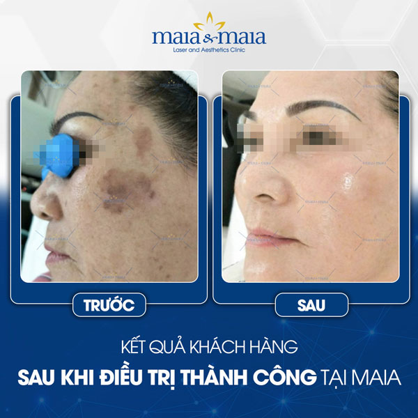 khách trị đồi mồi