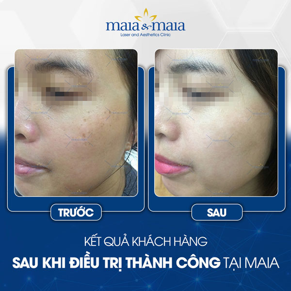 khách trị đốm tàn nhang