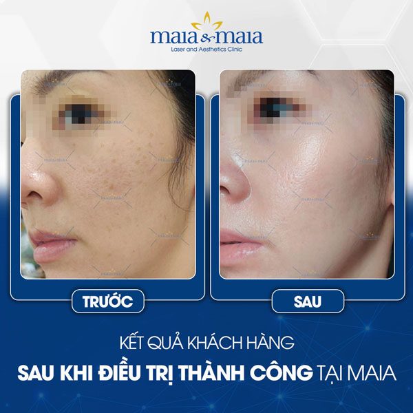 khách trị tàn nhang tại maia