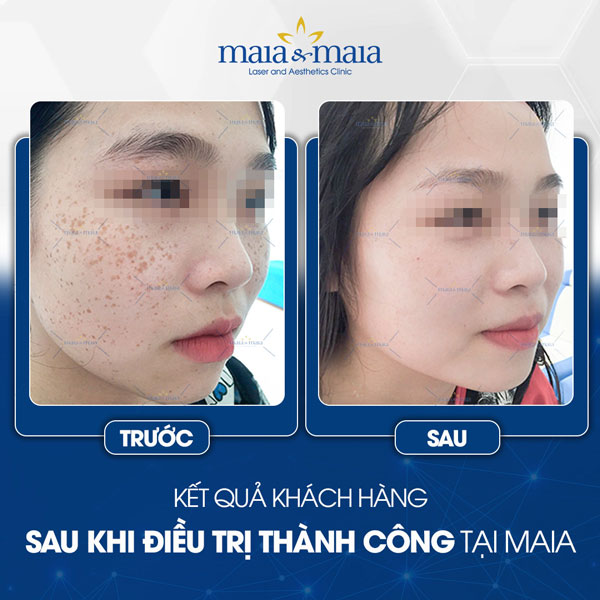 khách trị tàn nhang thành công tại maia