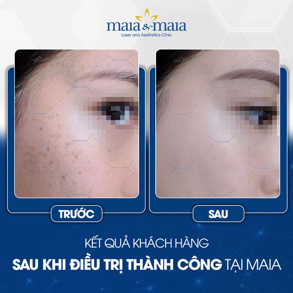 khách trị tàn nhang thành công