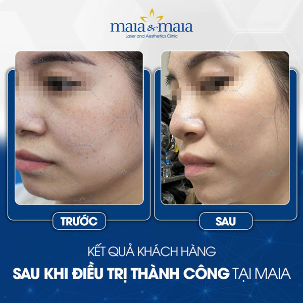 khách trị tàn nhang