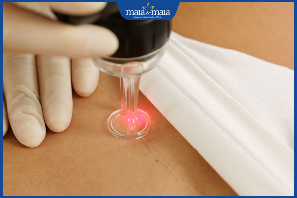 xóa sẹo mổ đẻ bằng laser