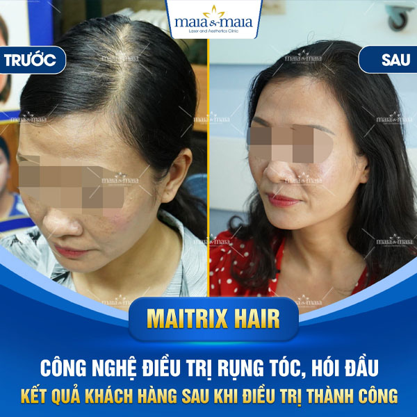 khách hàng trị rụng tóc