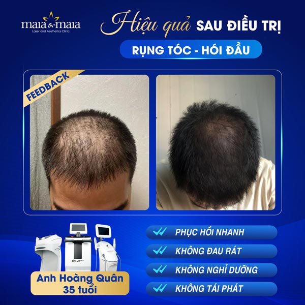 khách rụng tóc