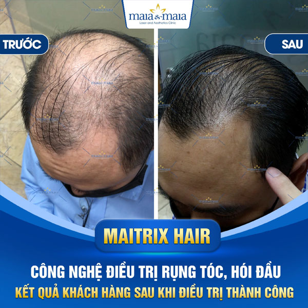 khách trị rụng tóc thành công tại maia