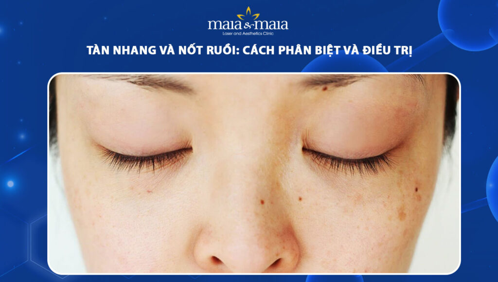 tàn nhang và nốt ruồi