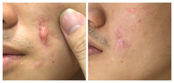 Hình ảnh: Khách hàng sau khi được hỗ trợ điều trị sẹo lồi
