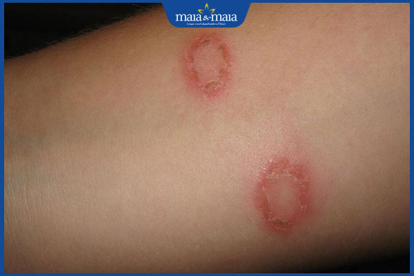 Hỗ trợ điều trị bệnh lang ben 3 1 2