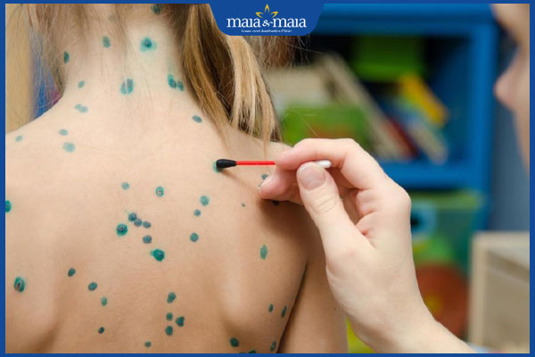 Nguyên nhân, triệu chứng, biến chứng thường gặp của bệnh thủy đậu 5 11