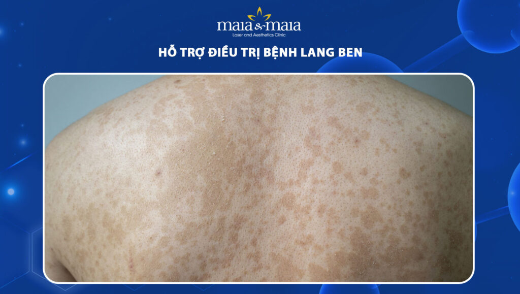 Hỗ trợ điều trị bệnh lang ben 1 12