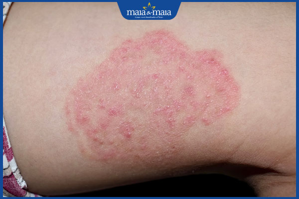 Hỗ trợ điều trị bệnh lang ben 2 13