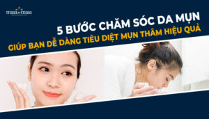 5 bước chăm sóc da mụn giúp bạn dễ dàng tiêu diệt mụn thâm hiệu quả