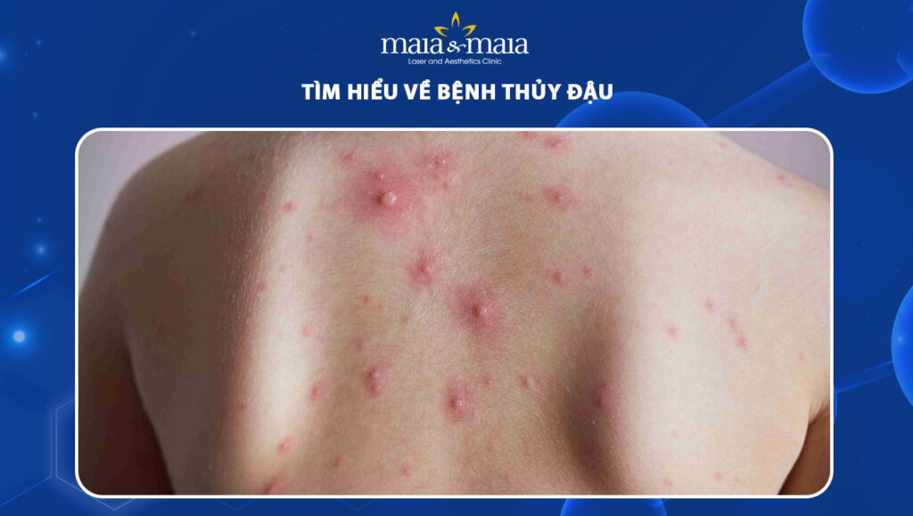 Nguyên nhân, triệu chứng, biến chứng thường gặp của bệnh thủy đậu 1 7 1