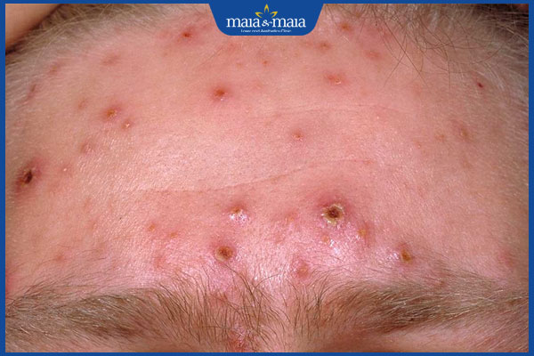 Nguyên nhân, triệu chứng, biến chứng thường gặp của bệnh thủy đậu 2 8 1