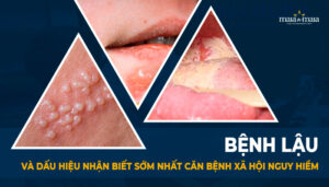 bệnh lậu và dấu hiệu nhận biết sớm nhất căn bệnh xã hội nguye hiểm