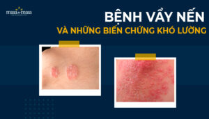 bệnh vẩy nến và những biến chứng khó lường