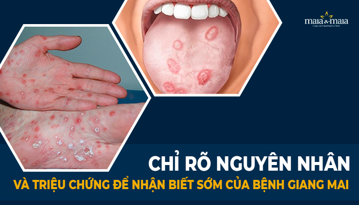 Nguyên nhân bệnh lậu giang mai: Tìm hiểu và cách phòng ngừa hiệu quả