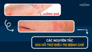 các nguyên tắc khi hỗ trợ điều trị bệnh ghẻ 1