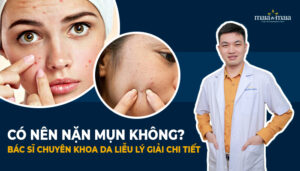 có nên nặn mụn không bác sĩ chuyên khoa da liễu lý giải chi tiết