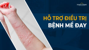 hỗ trợ điều trị bệnh mề đay