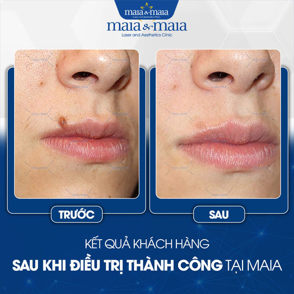 khách điều trị nốt ruồi thành công