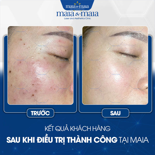 khách điều trị nốt ruồi