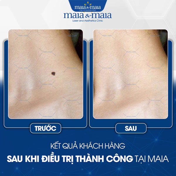 khách trị nốt ruồi