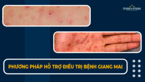phương pháp hỗ trợ điều trị bệnh giang mai