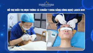 Trị mụn trứng cá bằng công nghệ laser diot