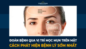 oán bệnh qua vị trí mọc mụn trên mặt cách phát hiện bệnh lý sớm nhất