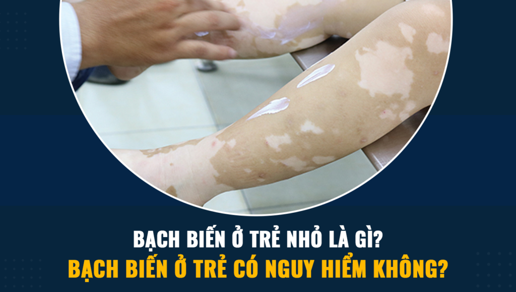 Bạch biến ở trẻ nhỏ là gì? Bạch biến ở trẻ có nguy hiểm không? 1 7........