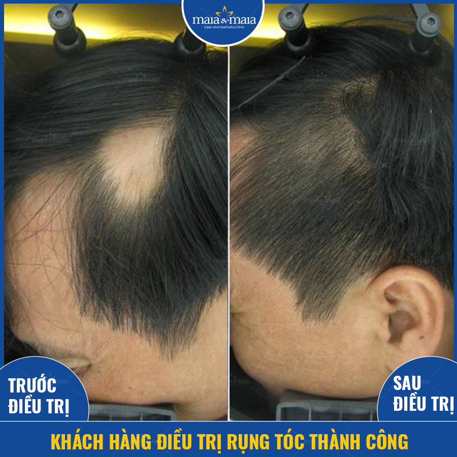 Hình ảnh khách hàng điều trị rụng tóc thành công