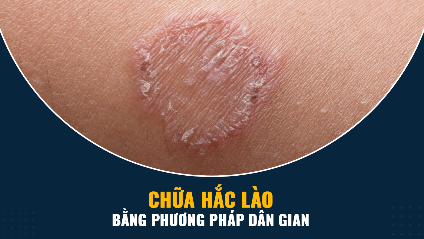 Có những bài thuốc dân gian nào chữa hắc lào ở vùng da nhạy cảm?
