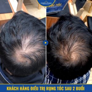 Hình ảnh khách hàng điều trị rụng tóc thành công