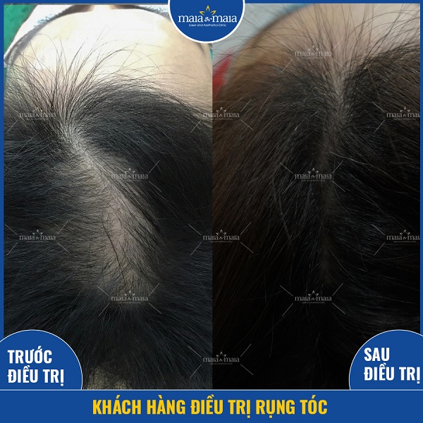 Hiệu quả sau hỗ trợ điều trị rụng tóc tại phòng khám Maia