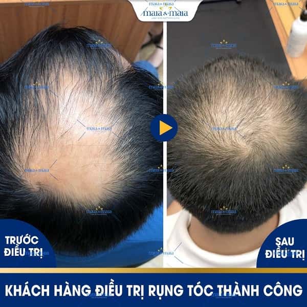 Cách trị hói đầu ở nam giới cực kỳ hiệu quả không phải ai cũng biết  Cấy  Tóc Quốc Tế