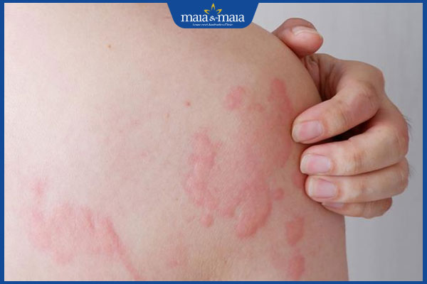 Mề Đay Là Gì? Cùng Maia&Maia Tìm Hiểu Về Bệnh Mề Đay 2 11