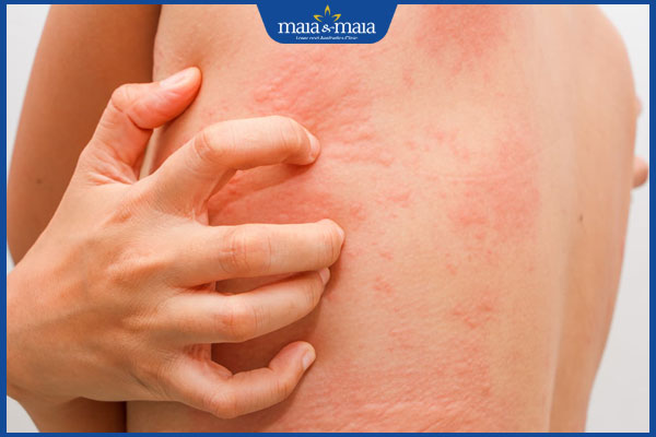 Mề Đay Là Gì? Cùng Maia&Maia Tìm Hiểu Về Bệnh Mề Đay 3 12