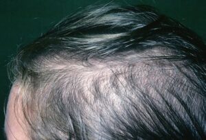 hair scalp s9 female hair loss