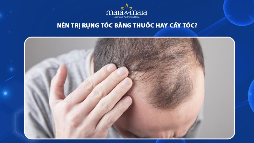 nên trị rụng tóc bằng thuốc hay cấy tóc