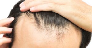 Tụt chân tóc vùng thái dương - Những biểu hiện ban đầu của rụng tóc hói đầu