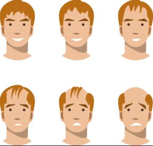 Người trẻ tuổi thường bị rụng tóc hói đầu do di truyền